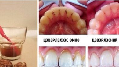 Photo of Шүдний эмч дээр очихгүйгээр шүдний чулуунаас хэрхэн салах вэ?